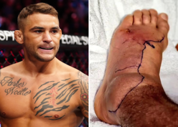 Dustin Poirier Ear: The Story Behind His Cauliflower Ear Condition!