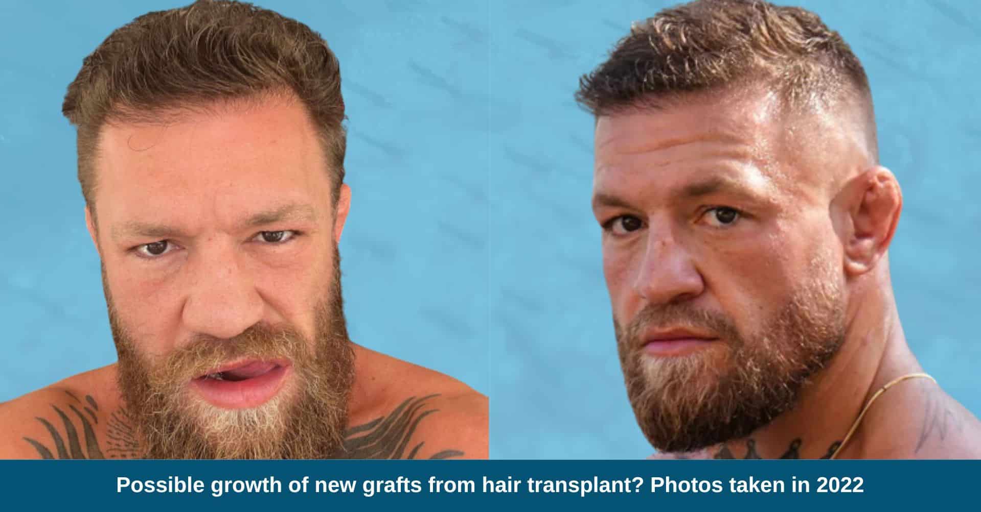 Conor McGregor Hairline: Is It Really That Bad? Lets Take a Closer Look at His Hair.