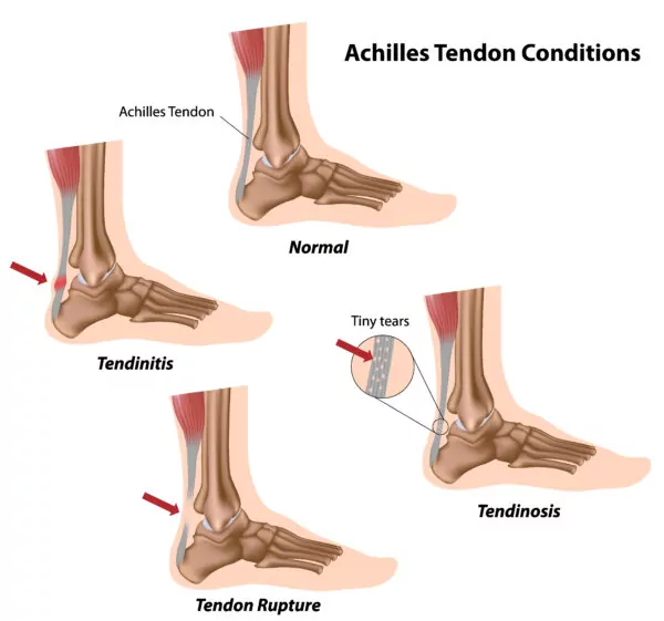 Ankle Bone NYT: Simple Guide to Understanding Your Ankle