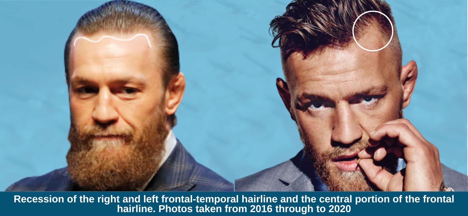 Conor McGregor Hairline: Is It Really That Bad? Lets Take a Closer Look at His Hair.