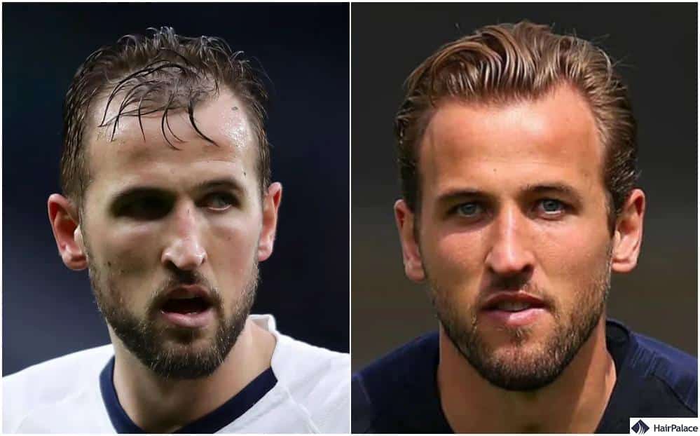 Kane With Hair: Check Out His Amazing Transformation Photos!